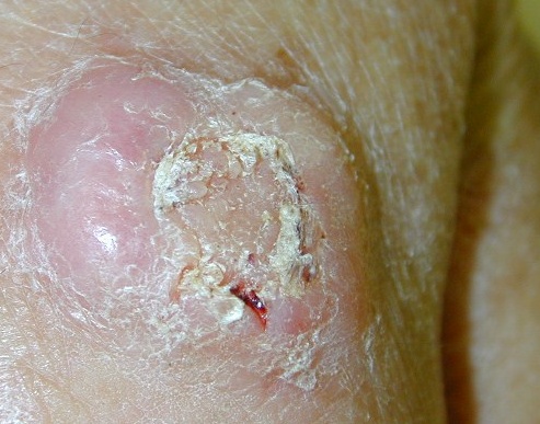 Download Epitelioma spinocell (493Wx387H)